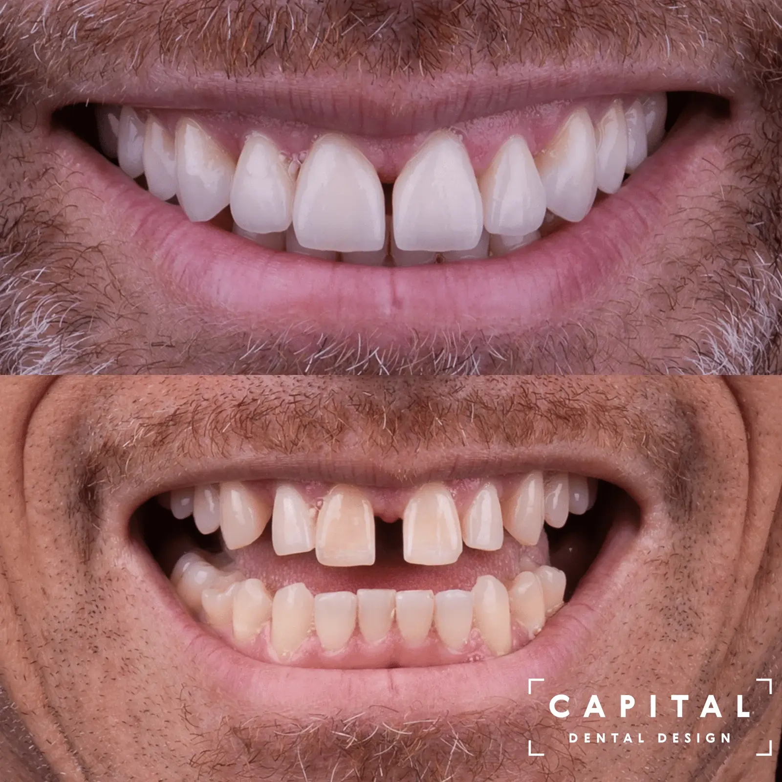 Before and after porcelain veneers