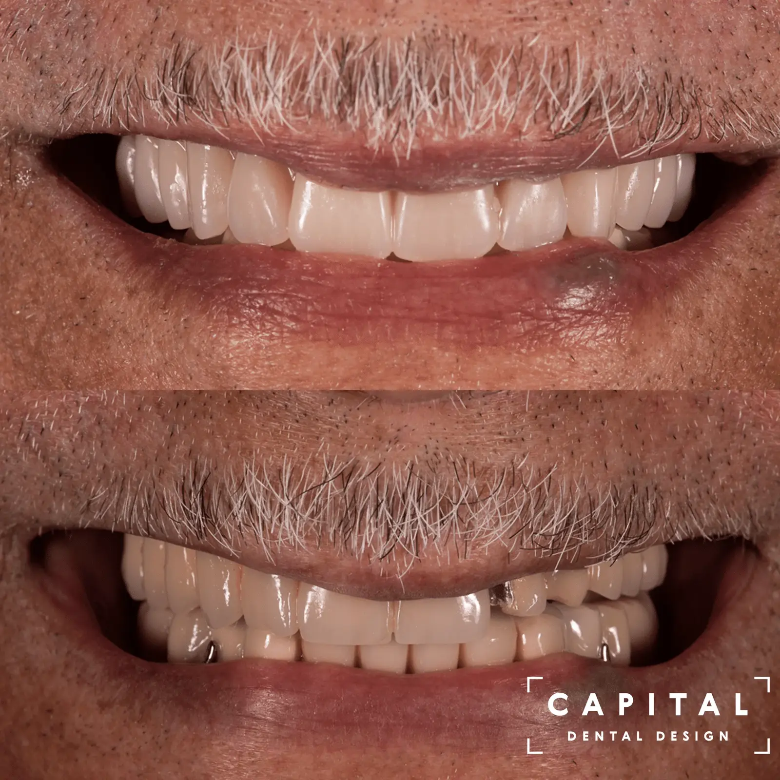 Smile Design results at Capital Dental Design Richmond VA