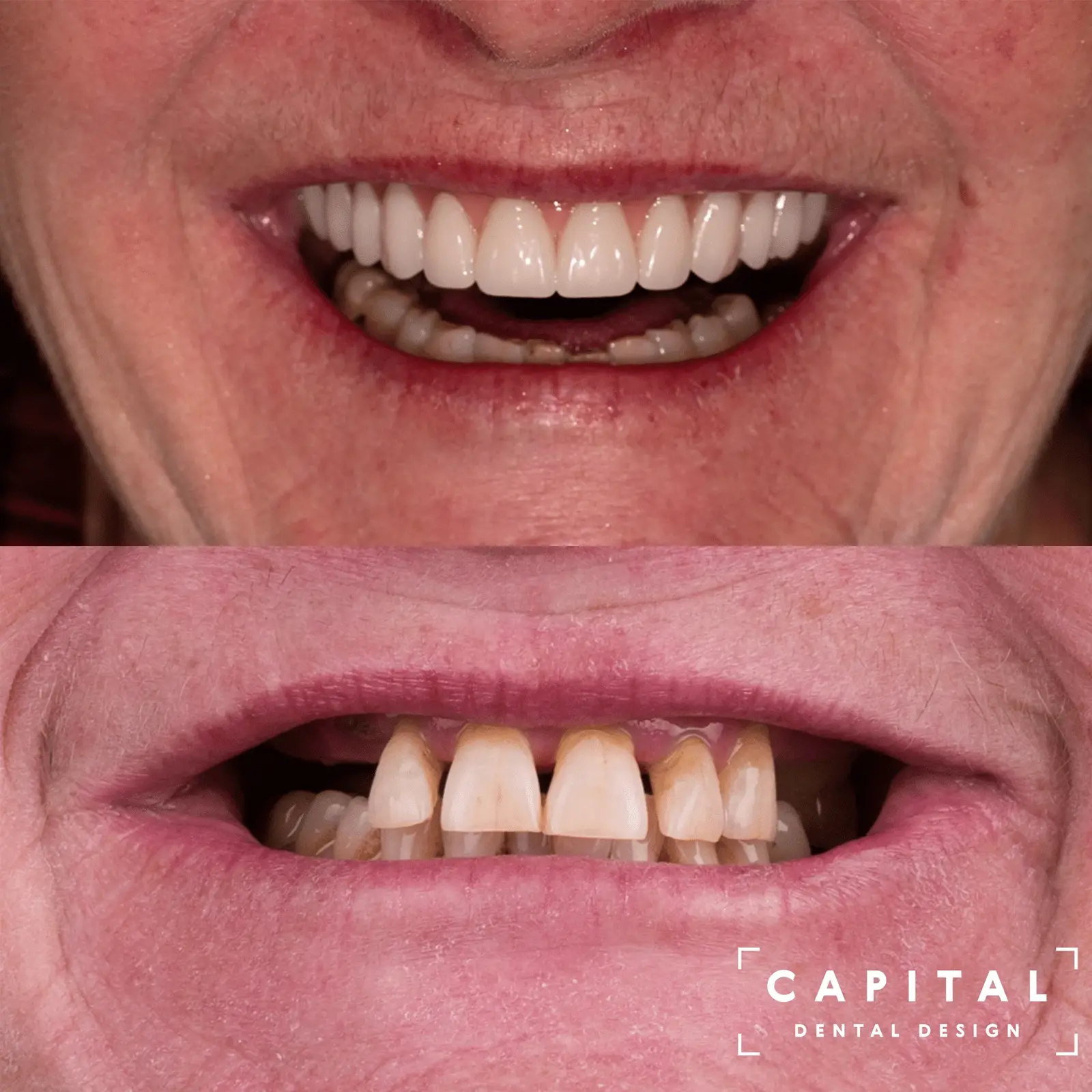 Invisalign results at Capital Dental Design Richmond VA
