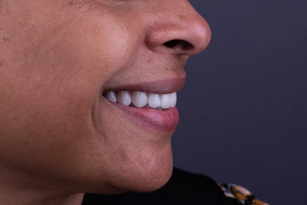 Porcelain veneer consultation at Capital Dental Design