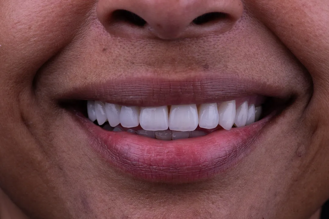 Smile design process