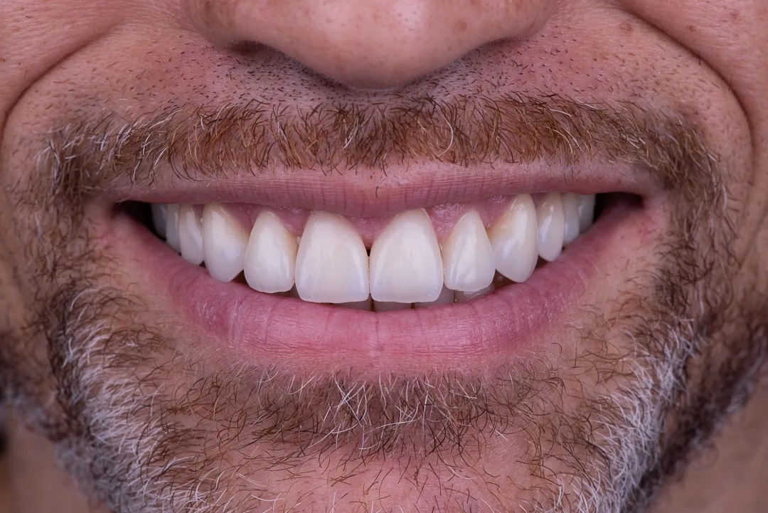 Porcelain veneers final result