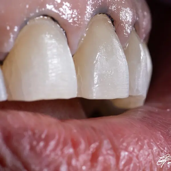 Minimal veneer preparation