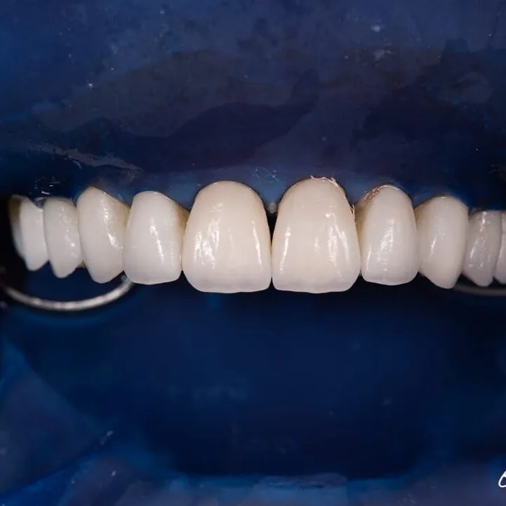 Step 9: Veneers bonded and isolation removed