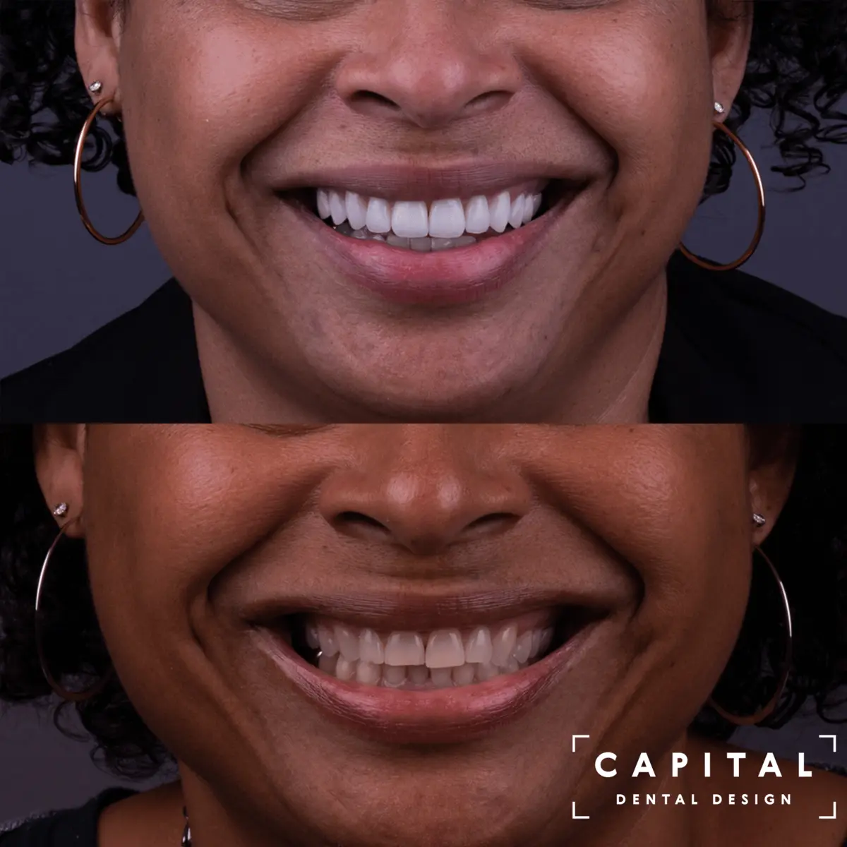 Porcelain Veneers case