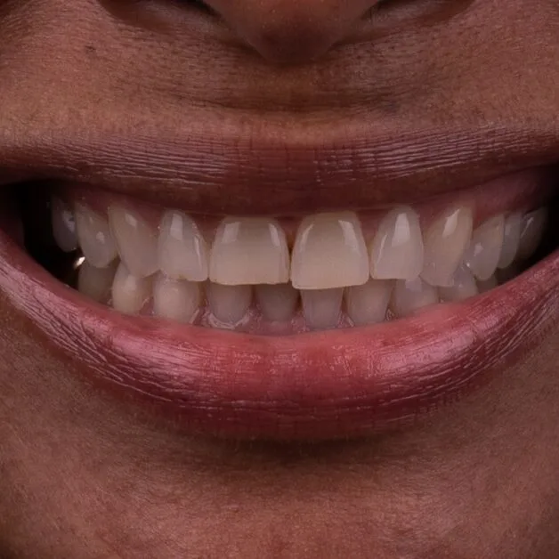 Step 2: Diagnostic analysis of smile proportions