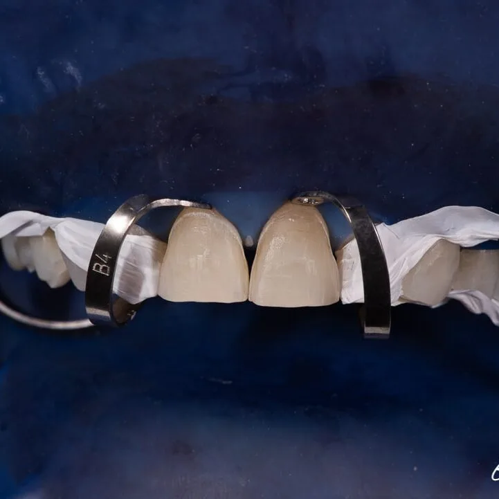 Step 8: Veneer bonding under total isolation