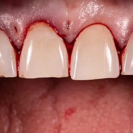 Step 6: Immediately post gum recontouring surgery