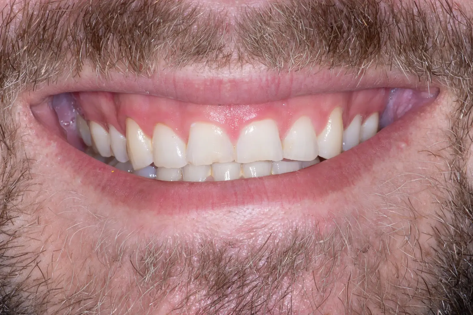 Case 11: Porcelain Veneers