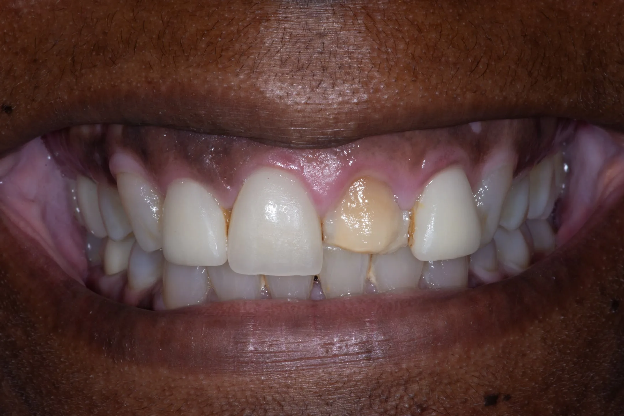 Case 12: Porcelain Veneers
