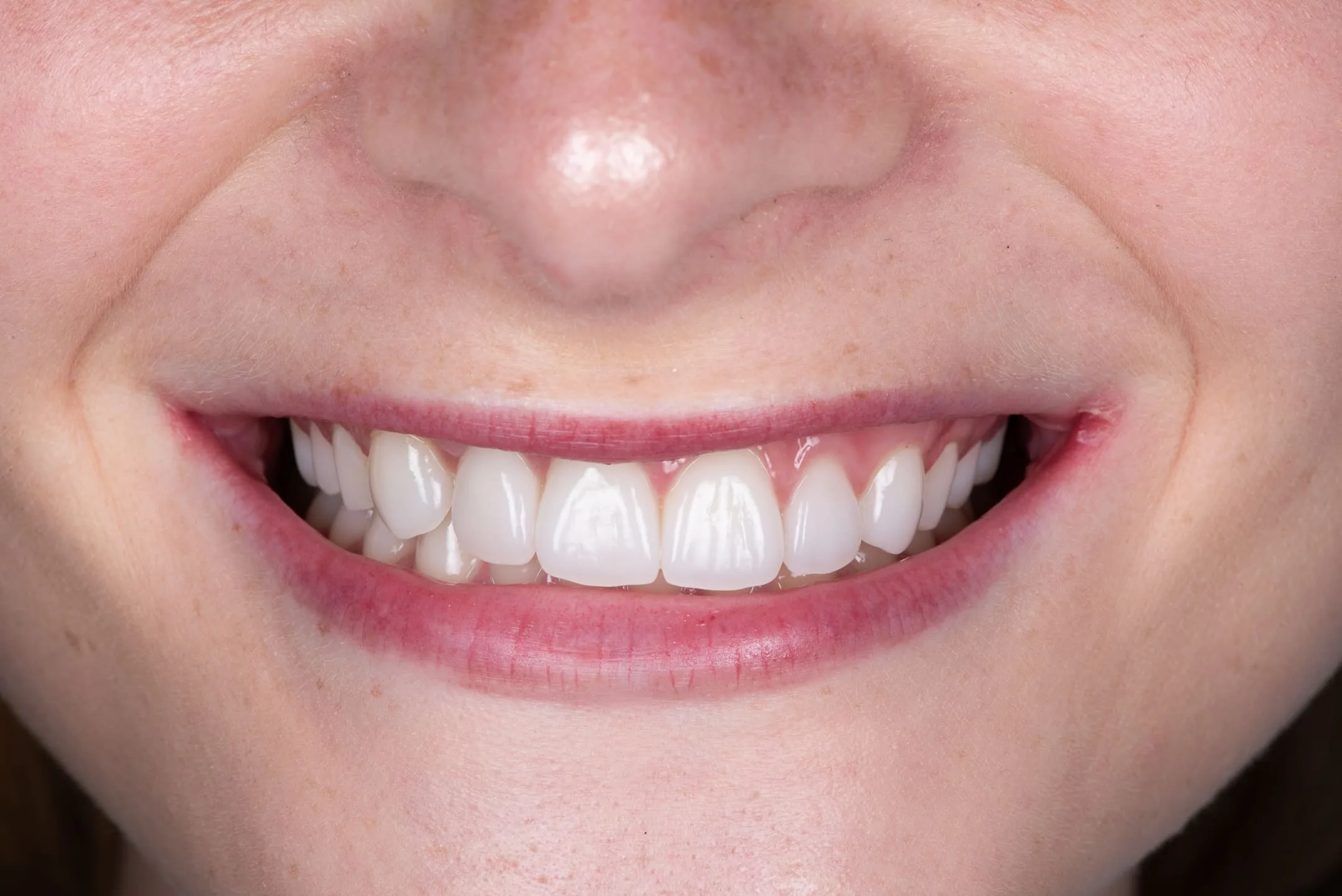 Case 14: Bridge + Veneers