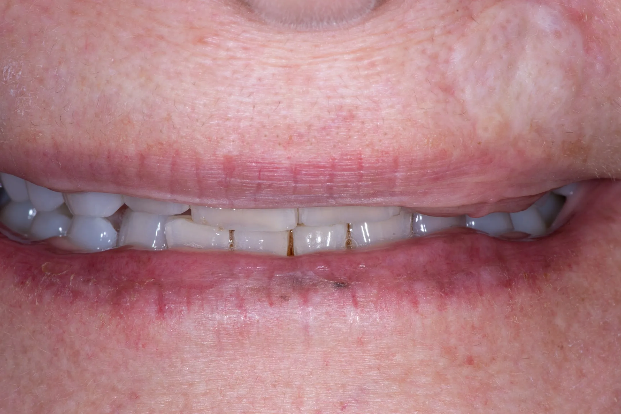 Porcelain Veneers case at Capital Dental Design