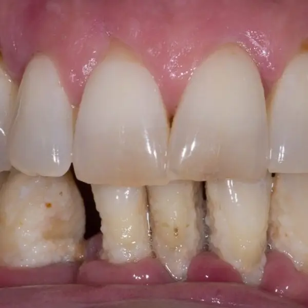 Failing dentition
