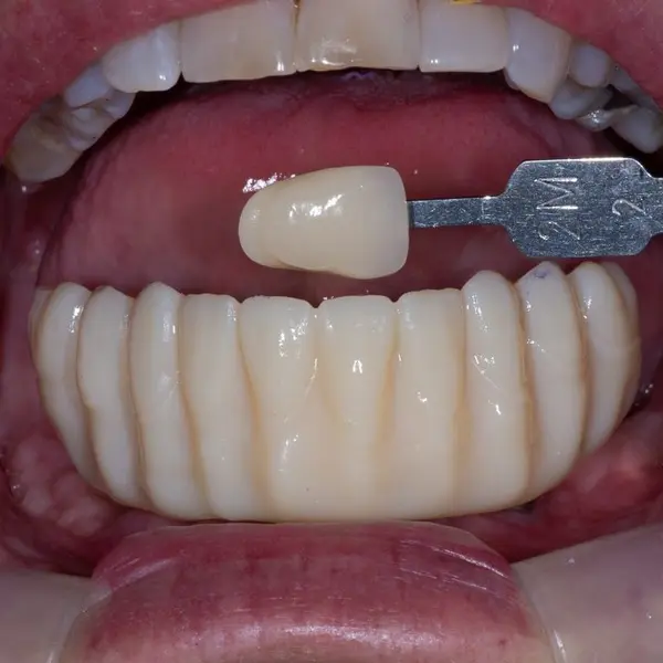 Final prosthetic prototype