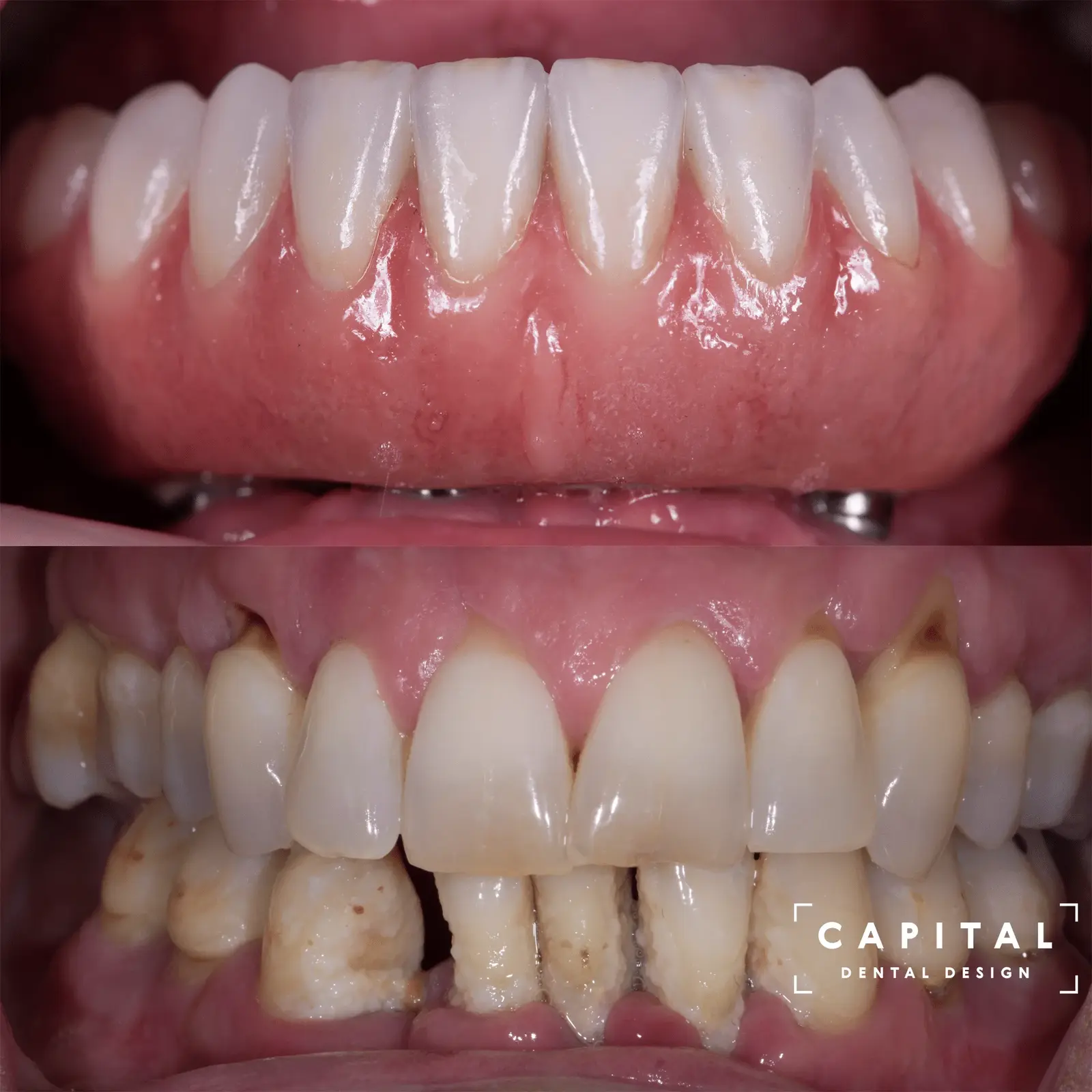 All-on-4 Hybrid case at Capital Dental Design