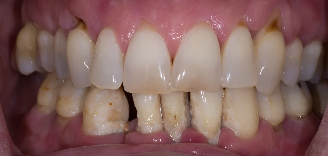Step 2: Transition