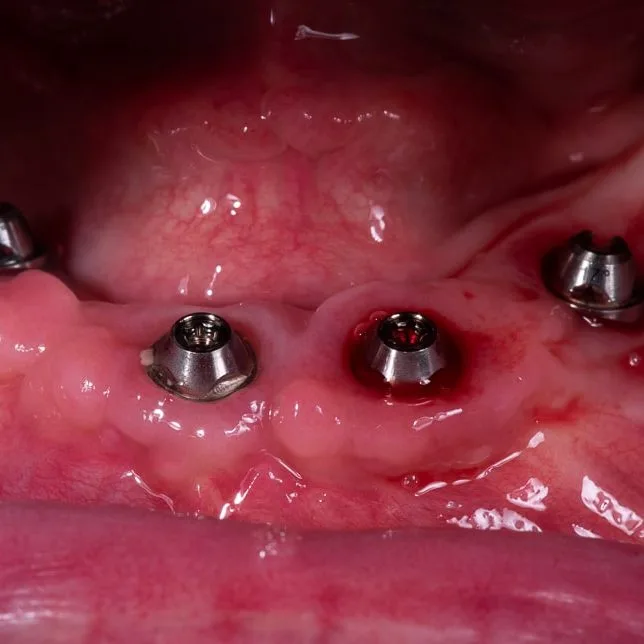 Step 6: Final Prosthetic Prototype