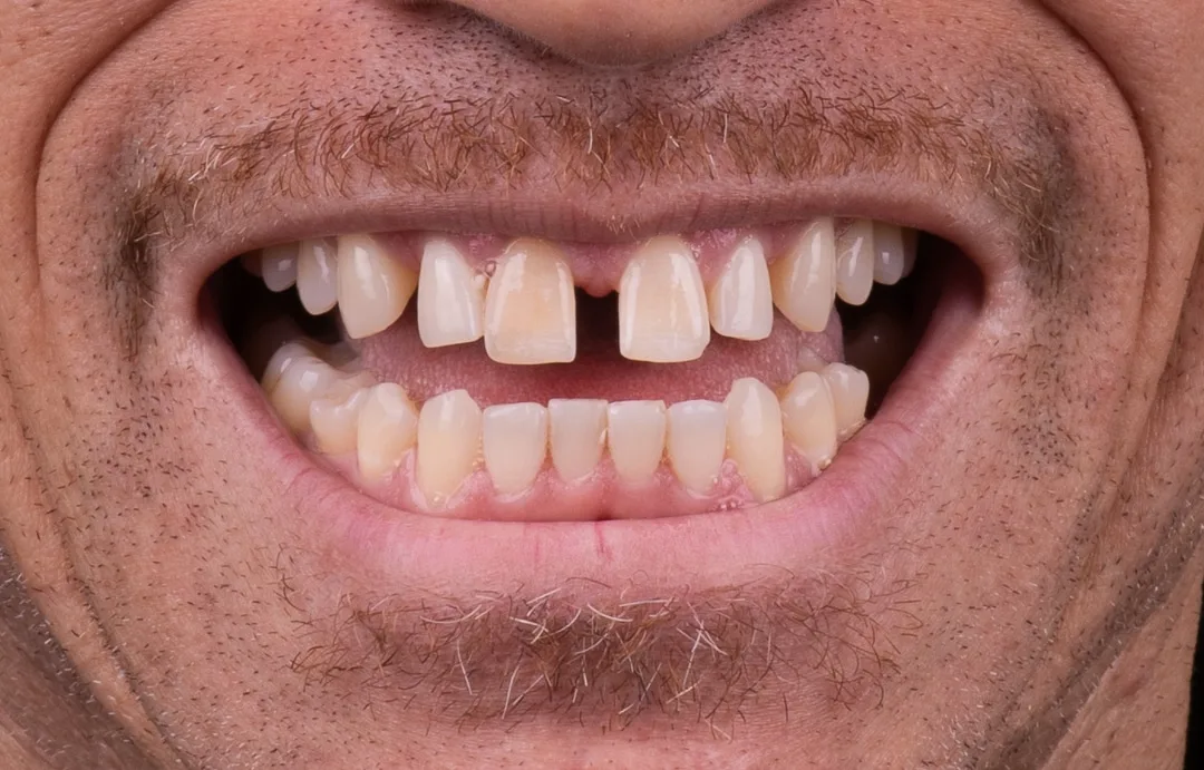 Case 03: Invisalign + Veneers
