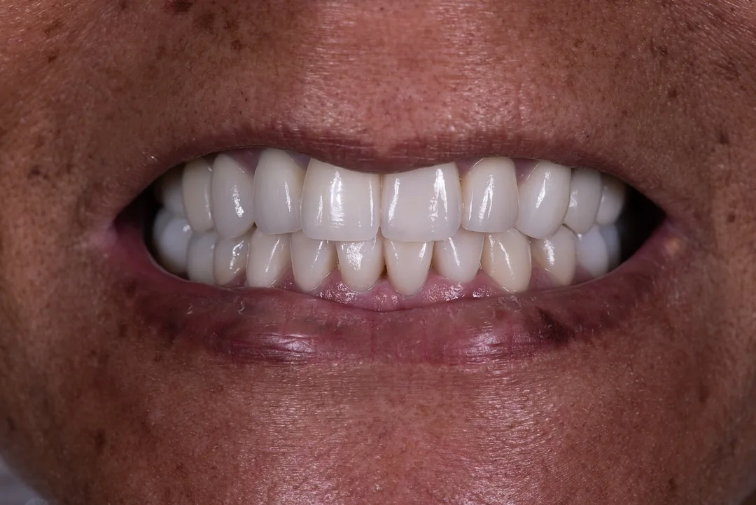 Full Mouth Restoration case at Capital Dental Design