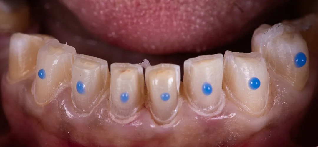 Step 3: Crown Removal