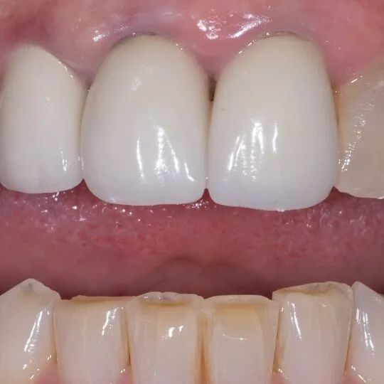 Step 7: Veneer Isolation