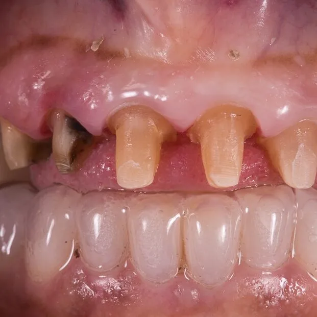 Step 8: Veneer Bonding