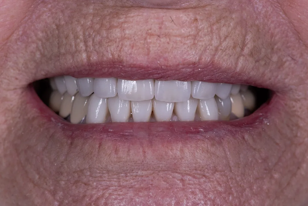 Case 05: Porcelain Veneers