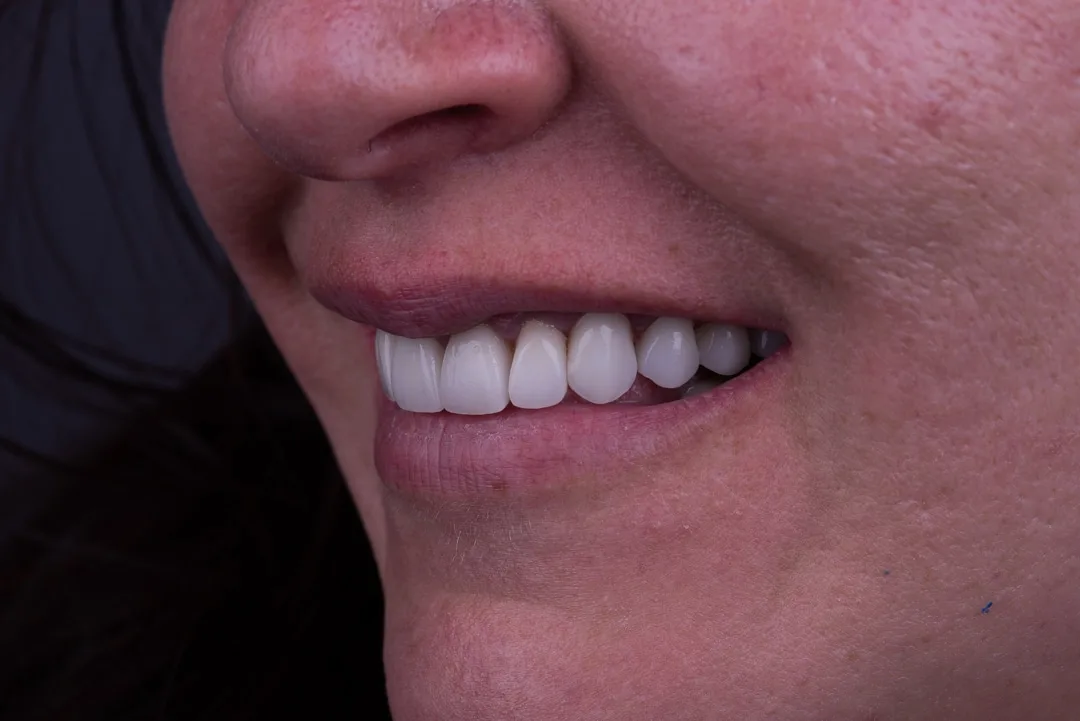 Case 08: Full Mouth Rehabilitation