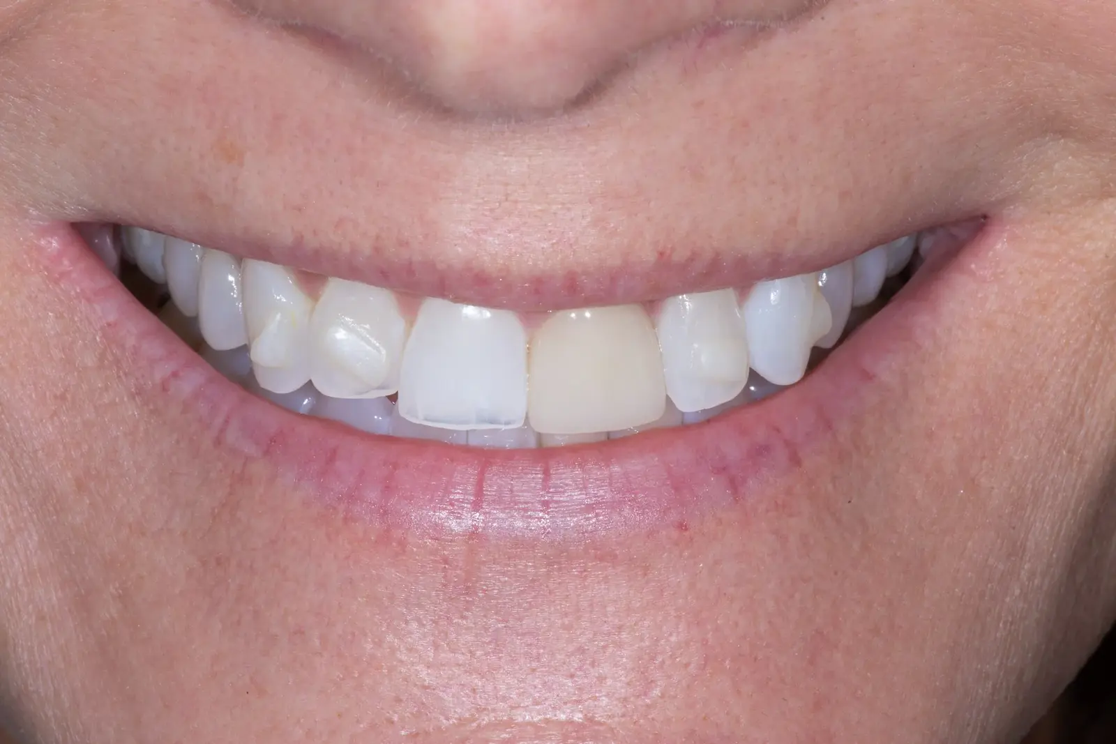 Case 09: Invisalign + Veneers