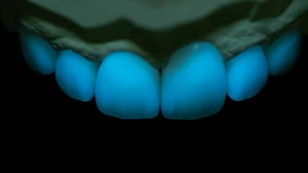 07: Porcelain Veneers