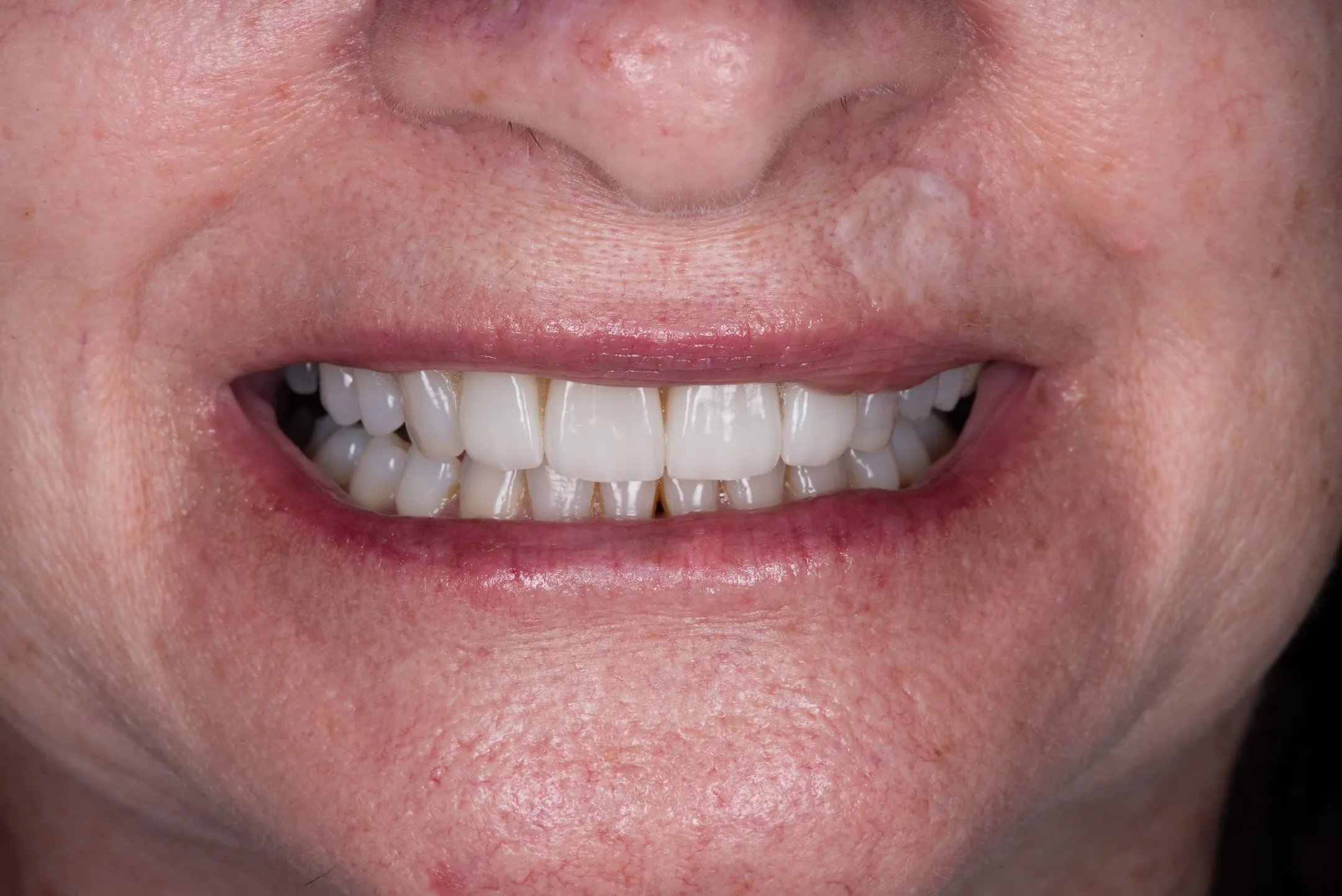 Invisalign results at Capital Dental Design Richmond VA