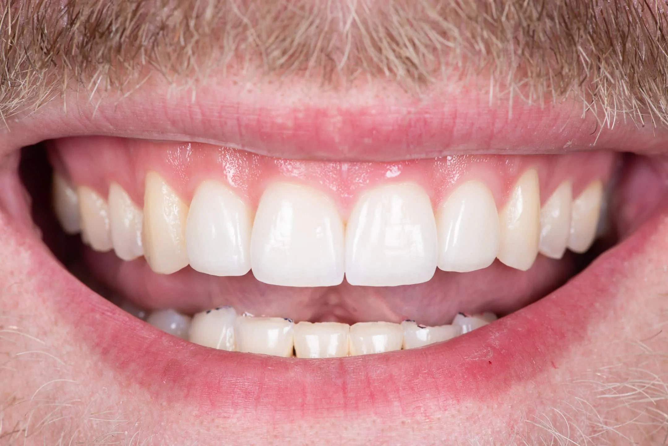 11: Porcelain Veneers