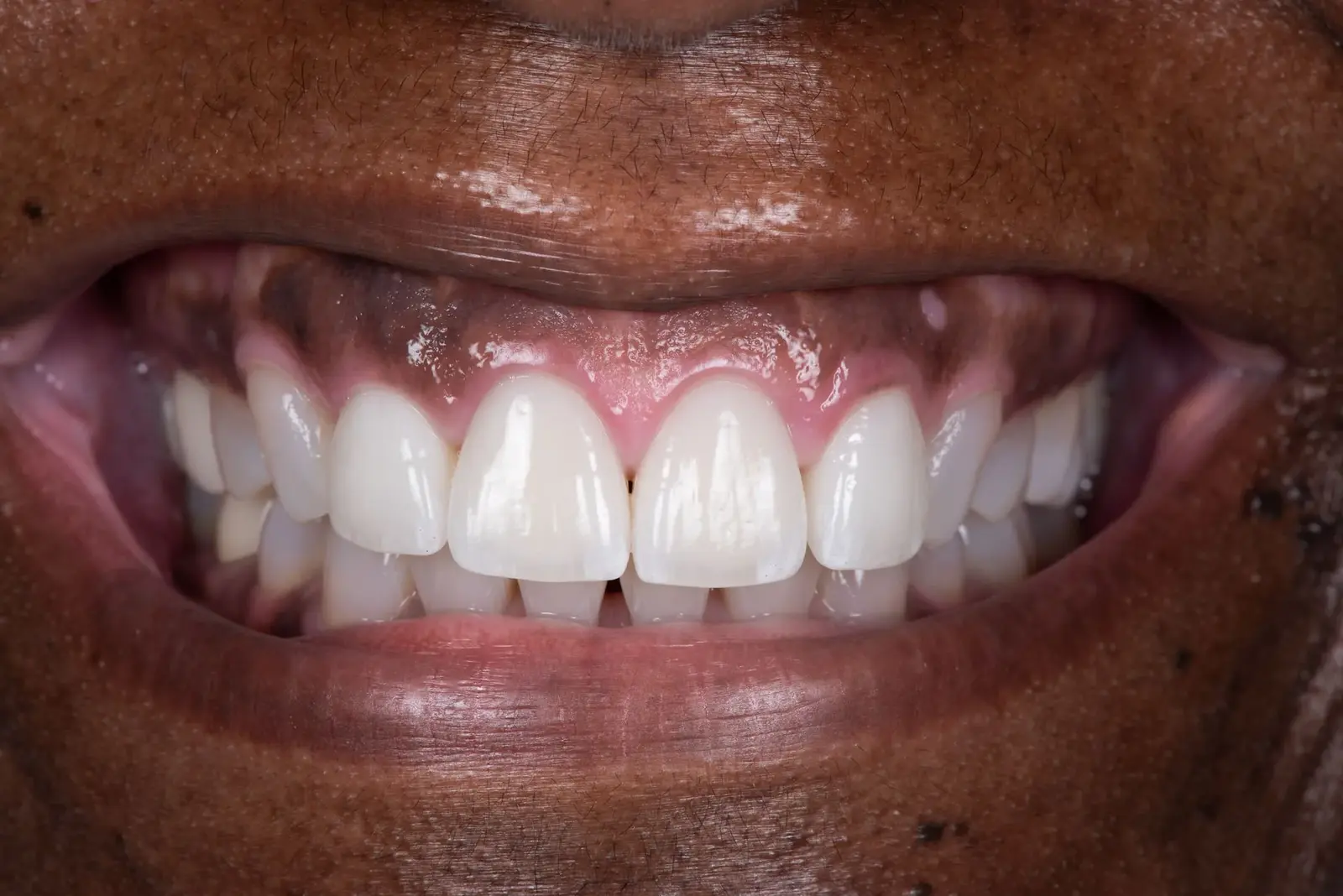 Invisalign results at Capital Dental Design Richmond VA