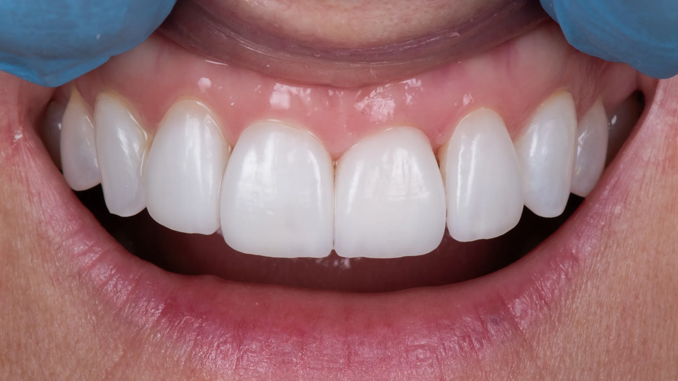 09: Invisalign + Veneers