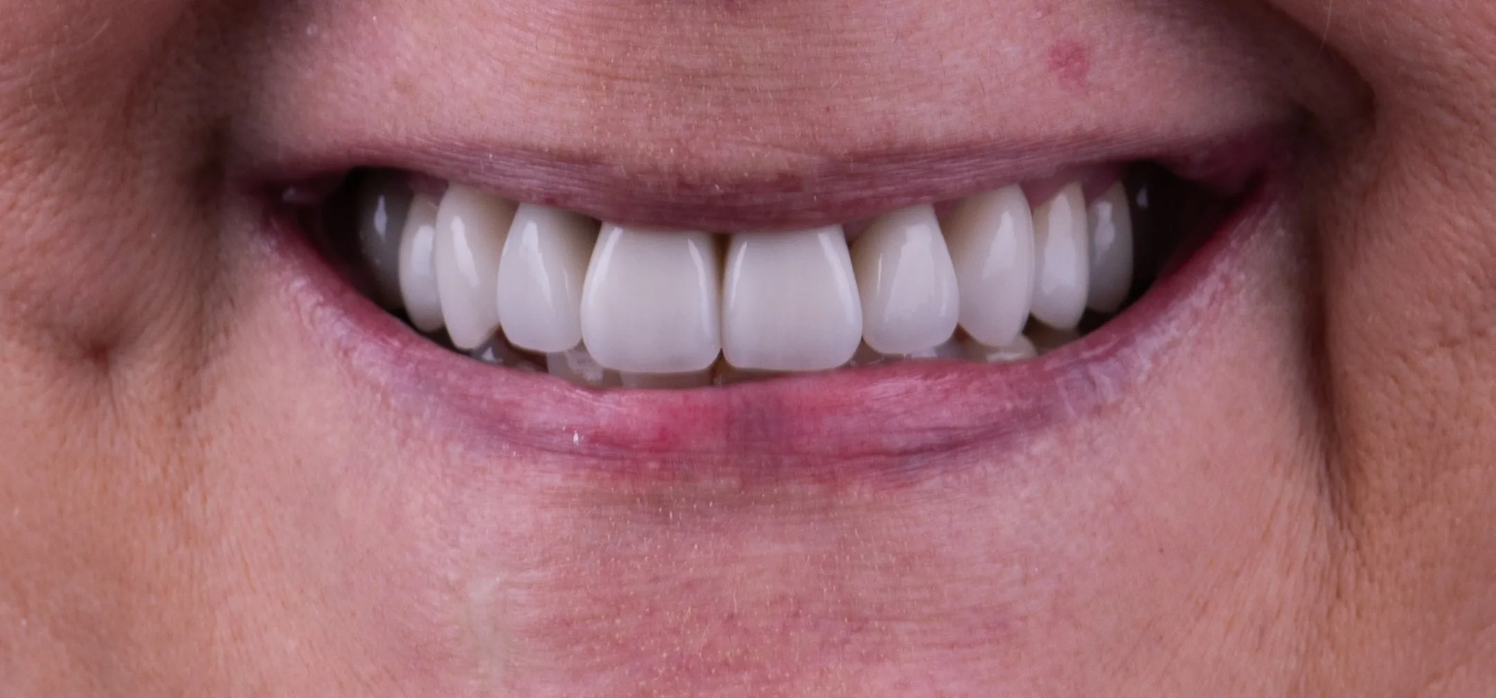 Invisalign results at Capital Dental Design Richmond VA