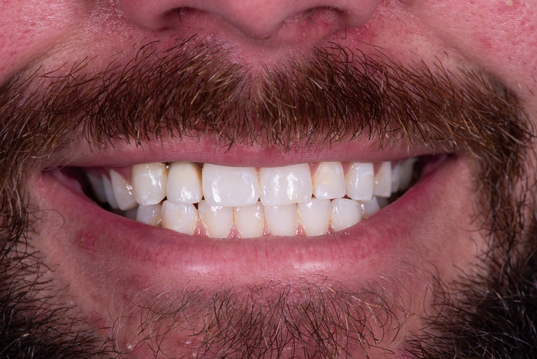 Teeth Whitening Richmond, VA - Capital Dental Design