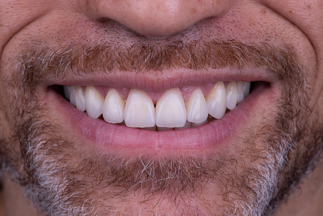 What are dental veneers? - Dental Design Smile