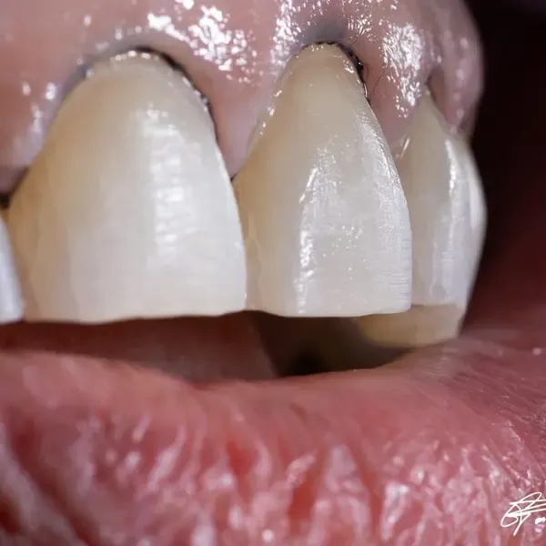 Minimal veneer preparation