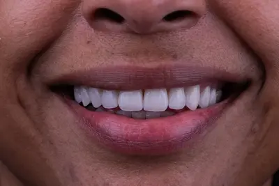 Smile design process