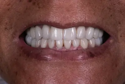 Full Mouth Restoration case