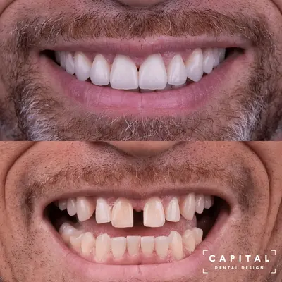Invisalign and Veneers case